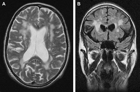 The Role of Imaging in the Diagnosis of Vascular Parkinsonism ...