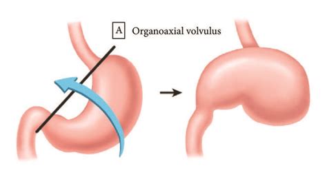 Organoaxial gastric volvulus. Rotation of the stomach along its long... | Download Scientific ...