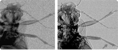 Phase-contrast X-ray imaging could identify tumors earlier