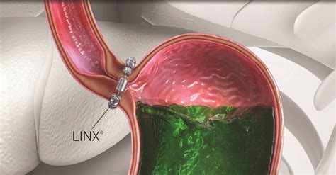 Living with GERD? Learn About LINX Procedure & Don’t Suffer Any Longer | Maryland Bariatrics