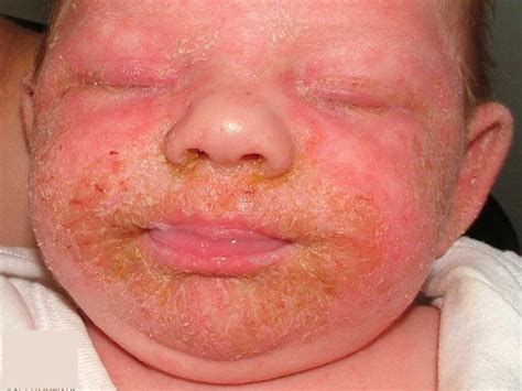 Infantile seborrheic dermatitis, causes, symptoms, diagnosis & treatment