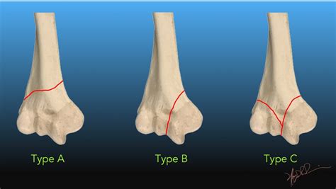 Distal Humerus Anatomy