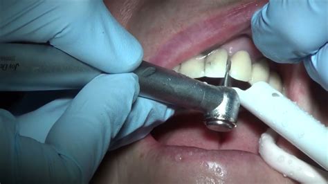 Removing canine teeth implant. Bone graft. Cosmetic Dentistry Los Angeles 818.776.0055 - YouTube