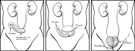 Brady Urology at Johns Hopkins Hospital: Quality of Life after Surgery for Bladder Cancer