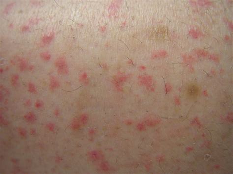 purpura causes - pictures, photos