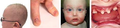 Ectodermal Dysplasia Symptoms | NFED