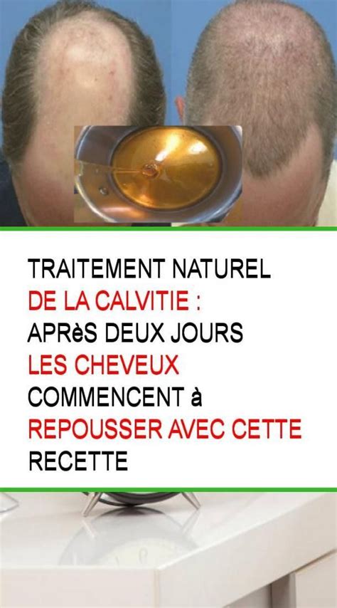 Traitement naturel de la calvitie : Après deux jours les cheveux ...