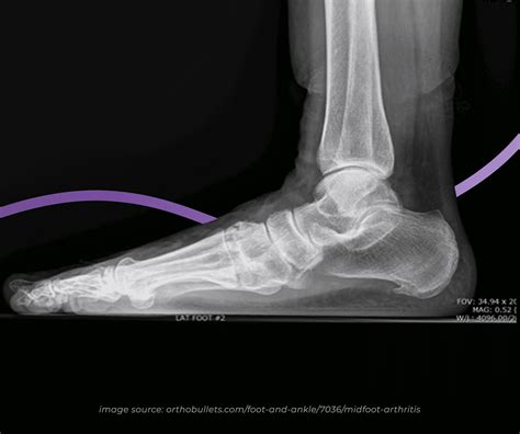 Mid Foot Osteoarthritis: Causes, Symptoms & Treatment | The Feet People Podiatry