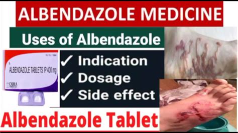 Albendazole tablets uses || ip 400mg || doses for adults and children and common side effects ...