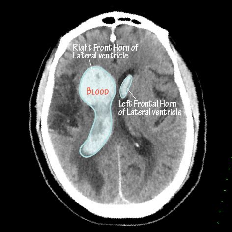 Neuroanatomy Glossary: Intraventricular Hemorrhage | ditki medical ...