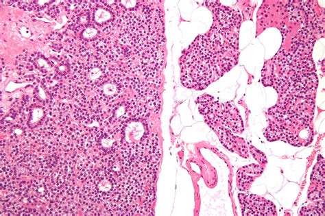 Parathyroid adenoma - wikidoc