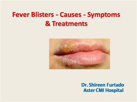 Fever Blisters - Causes - Symptoms and Treatments - Health Vision