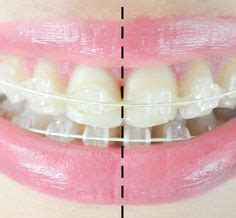 14 Radiance Plus Clear Sapphire Braces - Before and After ideas ...