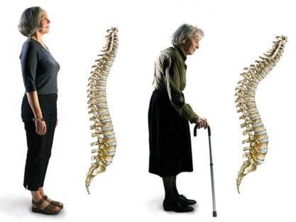 Figure No. 2: Postural changes in the elderly. | Download Scientific ...