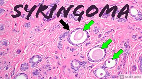 Syringoma Histology