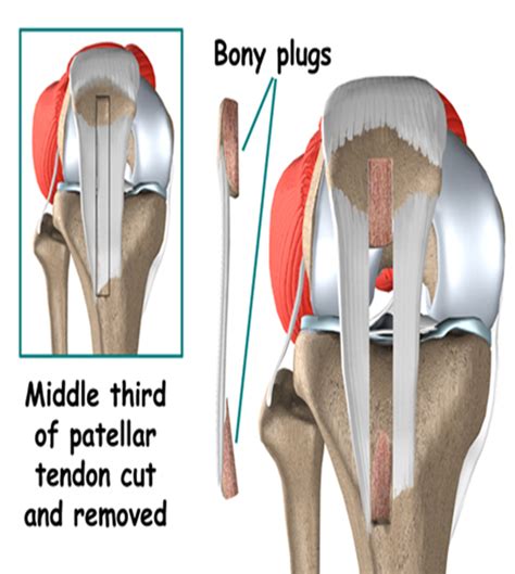 Acl Tear Graft