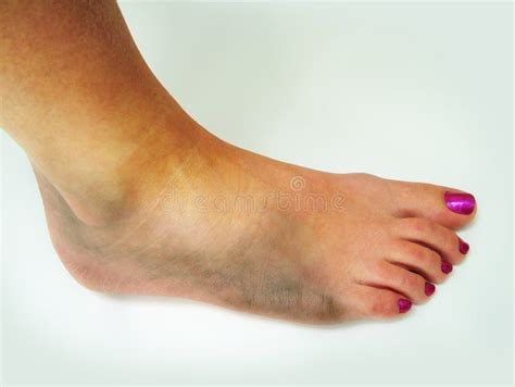 Bruised Ankle Stock Photos - Image: 8647723