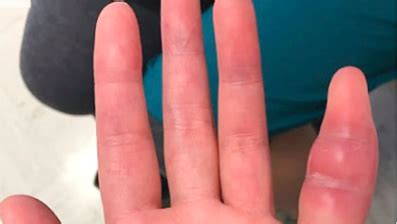 Woman's swollen pinky finger was rare sign of tuberculosis, UCSF doctors say