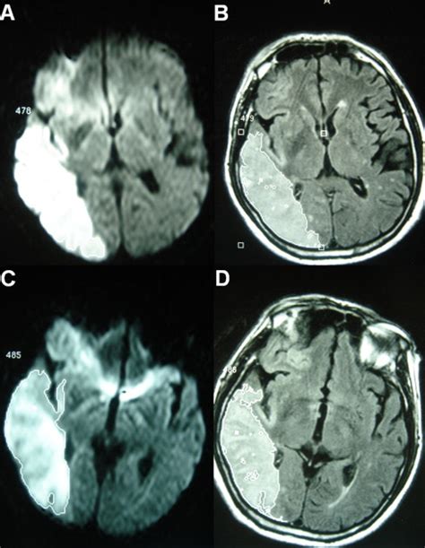 Diffusion weighted imaging and estimation of prognosis using apparent ...