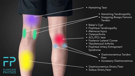 Knee Pain Location Chart - Find the Cause of Your Knee Pain