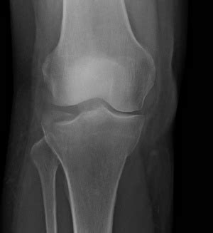 Tibial Plateau Fractures - Physiopedia