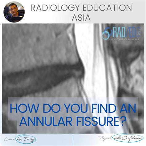 ANNULAR FISSURE TEAR MRI RADIOLOGY LUMBAR SPINE (VIDEO) - Radedasia