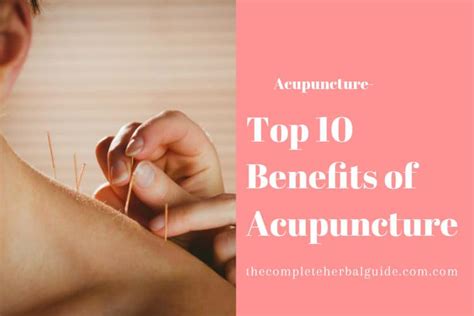 Top 10 Benefits of Acupuncture