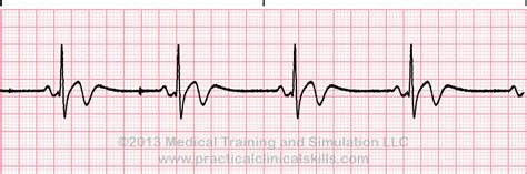 Sinus Rhythms Reference Page - EKG.Academy