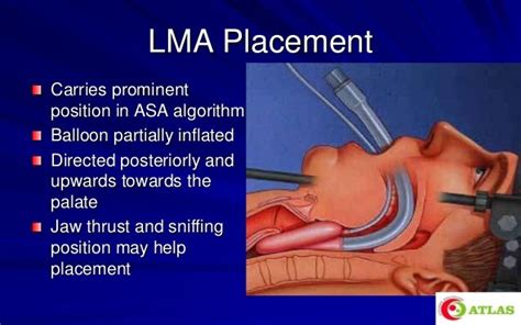 Laryngeal Mask Airway & Igel - An Introduction