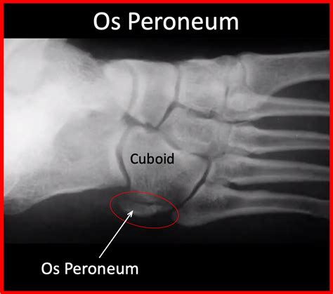 Os Peroneum Syndrome -Painful Os Peroneum - FootEducation