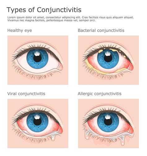 Prirodni lijek za konjuktivitis: Naši stari znaju što sve pomaže kao narodni lijek za ...