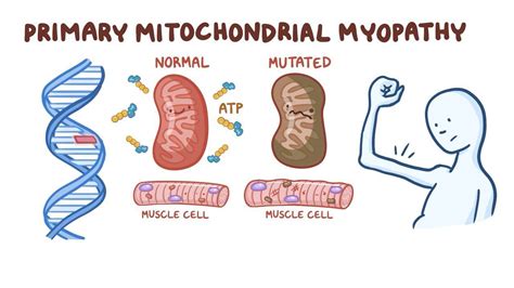 Mitochondrial myopathy - Osmosis