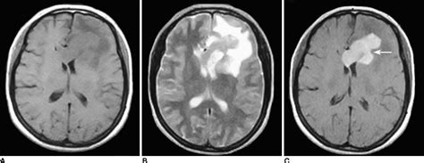 Figure 3 from MRI Findings of Primary CNS Lymphoma in 26 Immunocompetent Patients | Semantic Scholar