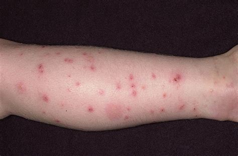 Flea Bites on Humans - Pictures, Symptoms and Treatment