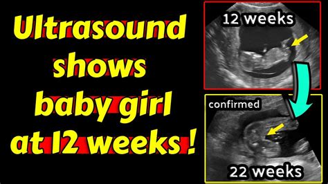 Ultrasound shows baby girl at 12 weeks pregnancy ! - YouTube