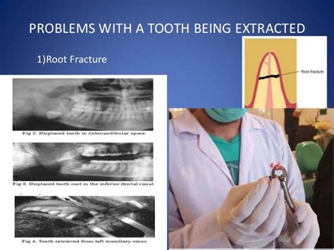 Complications of tooth extraction and its management (oral surgery)