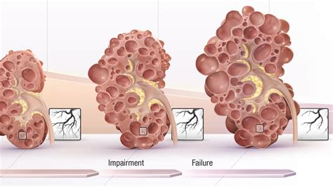 Medical Illustration: Kidney Disease Progression in ADPKD | Medical ...