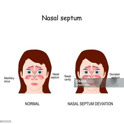 Nasal Septum Deviation Stock Illustration - Download Image Now - Septum ...