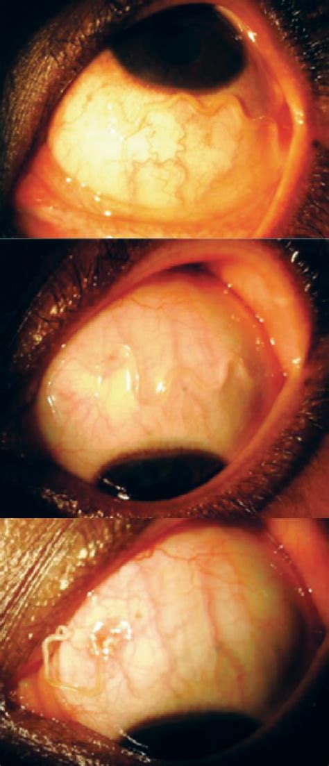 Loa Loa Filariasis (African Eye Worm) - EyeWiki