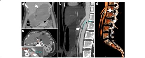 Sma Syndrome Radiology