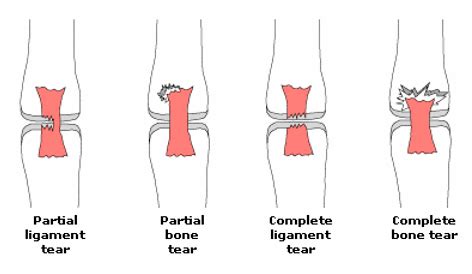 Ligament and Tendon Injuries - Premier Physiotherapy in DublinPremier Physiotherapy in Dublin