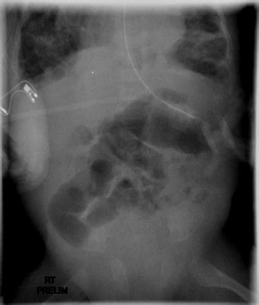 Hirschsprung disease | Image | Radiopaedia.org