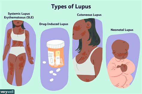 Lupus: Symptoms, Causes, Diagnosis, Treatment, and Coping