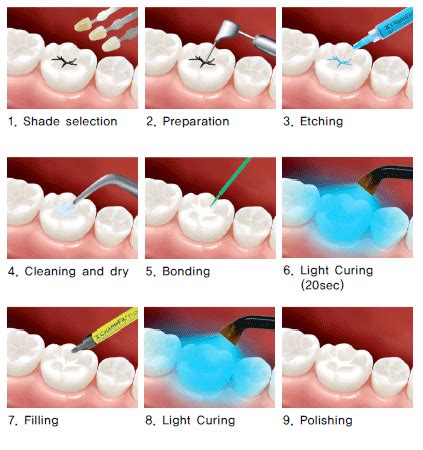 Composite fillings – Dentabode