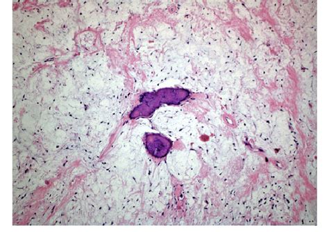 Odontogenic Myxoma Histology