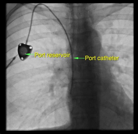 Chemotherapy access (port insertion and removal) - Dr. Eileen Morrisroe