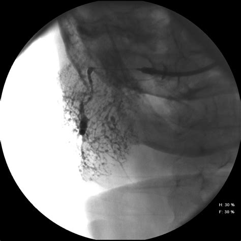 Sialogram Left Parotid Sjogrens Syndrome | Iowa Head and Neck Protocols