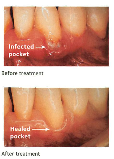 Gum Disease in Lake Worth, Palm Springs | Royal Palm Beach, FL Dentist | Family Dentistry of ...