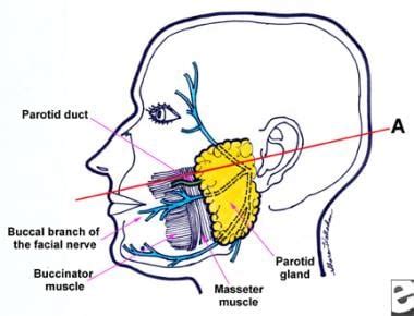 Parotid Duct Injuries: Practice Essentials, History of the Procedure ...