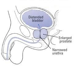 Enlarged Prostate (Benign Prostatic Hyperplasia) Guide: Causes ...